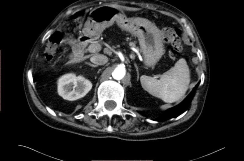 File:Abdominal aortic interposition tube graft and aneurysm thrombosis (Radiopaedia 71438-81857 Axial C+ arterial phase 18).jpg