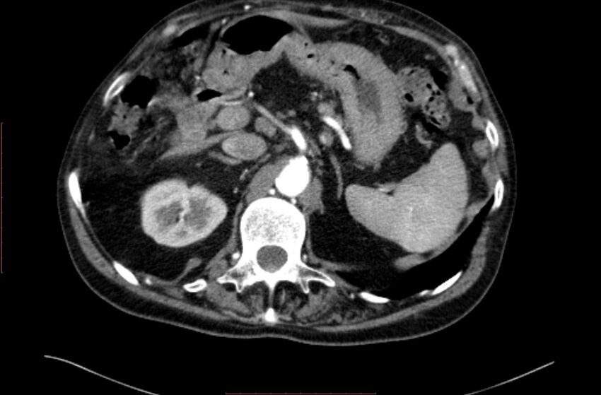 Abdominal aortic interposition tube graft and aneurysm thrombosis (Radiopaedia 71438-81857 Axial C+ arterial phase 18).jpg