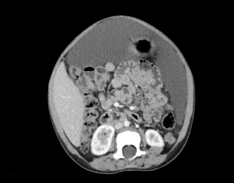 File:Abdominal premesenteric cystic lymphangioma (Radiopaedia 82995-97350 Axial C+ portal venous phase 30).jpg