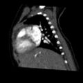 Aberrant left pulmonary artery (pulmonary sling) (Radiopaedia 42323-45435 Sagittal C+ arterial phase 17).jpg