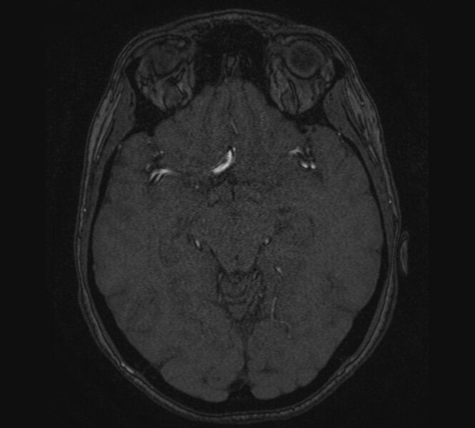 File:Accessory middle cerebral artery and ICA aneurysm (Radiopaedia 22656-22674 MRA 56).jpg