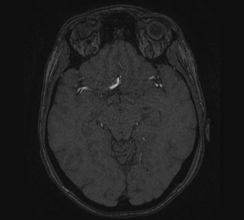 Accessory middle cerebral artery and ICA aneurysm (Radiopaedia 22656-22674 MRA 56).jpg