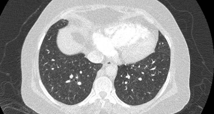 Accessory right inferior hepatic vein (Radiopaedia 65245-74259 Axial lung window 56).jpg