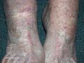 Actinic Keratoses affecting the legs and feet (DermNet NZ lesions-ak-legs-565).jpg