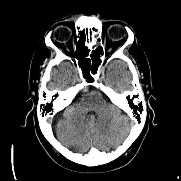 File:Acute A3 occlusion with ACA ischemic penumbra (CT perfusion) (Radiopaedia 72036-82525 Axial non-contrast 11).jpg