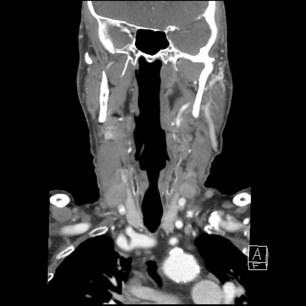 File:Acute ICA ischemic penumbra due to high-grade CCA stenosis (CT perfusion) (Radiopaedia 72038-82530 Coronal C+ arterial phase 15).jpg