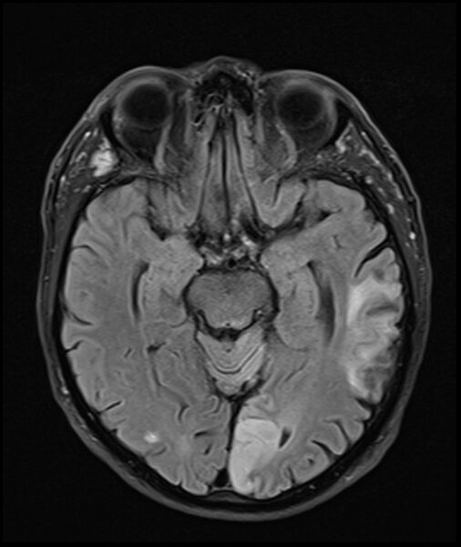 File:Acute P1 occlusion with PCA ischemia penumbra (CT perfusion) (Radiopaedia 72084-82590 Axial FLAIR 14).jpg