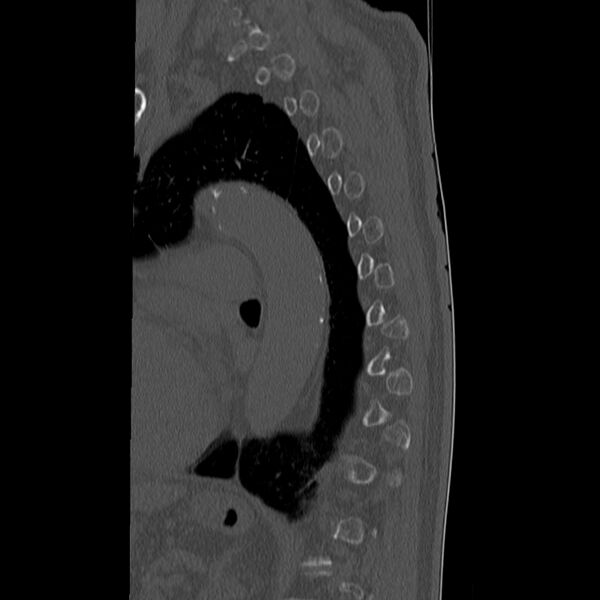 File:Acute and chronic vertebral compression fractures (Radiopaedia 31608-32494 Sagittal bone window 28).jpg