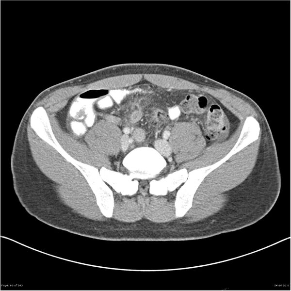 File:Acute appendicitis (Radiopaedia 25364-25615 B 50).jpg