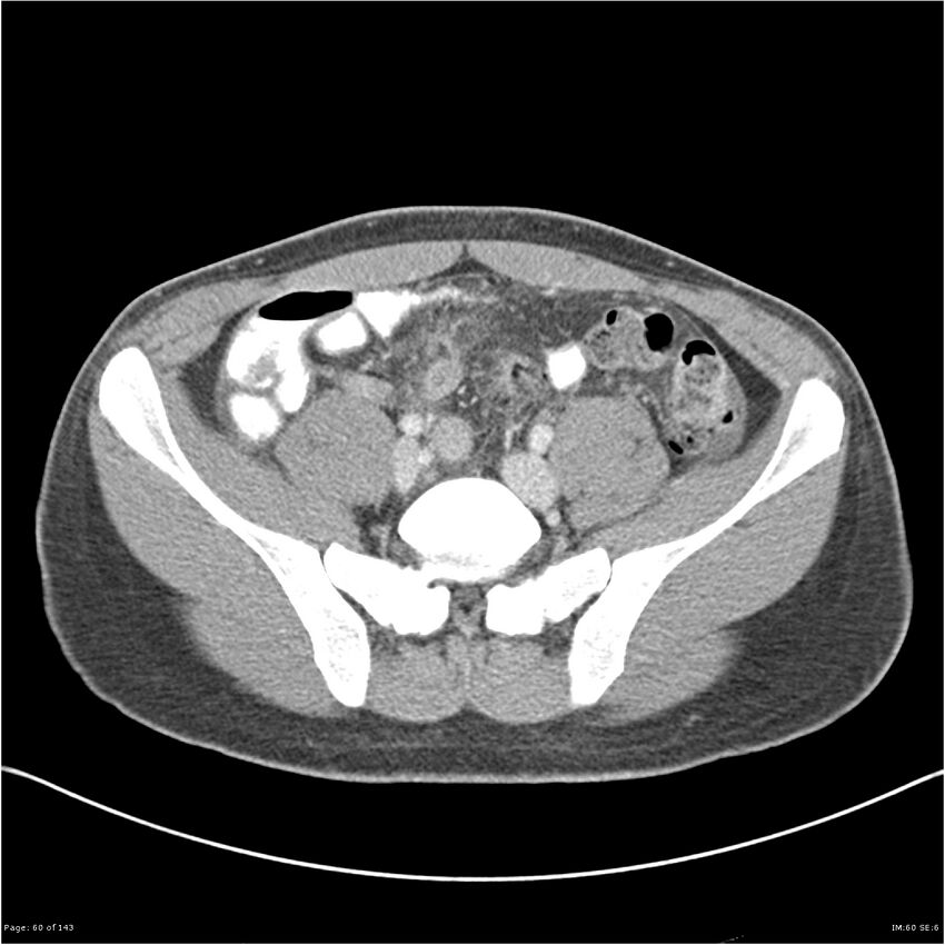 Acute appendicitis (Radiopaedia 25364-25615 B 50).jpg