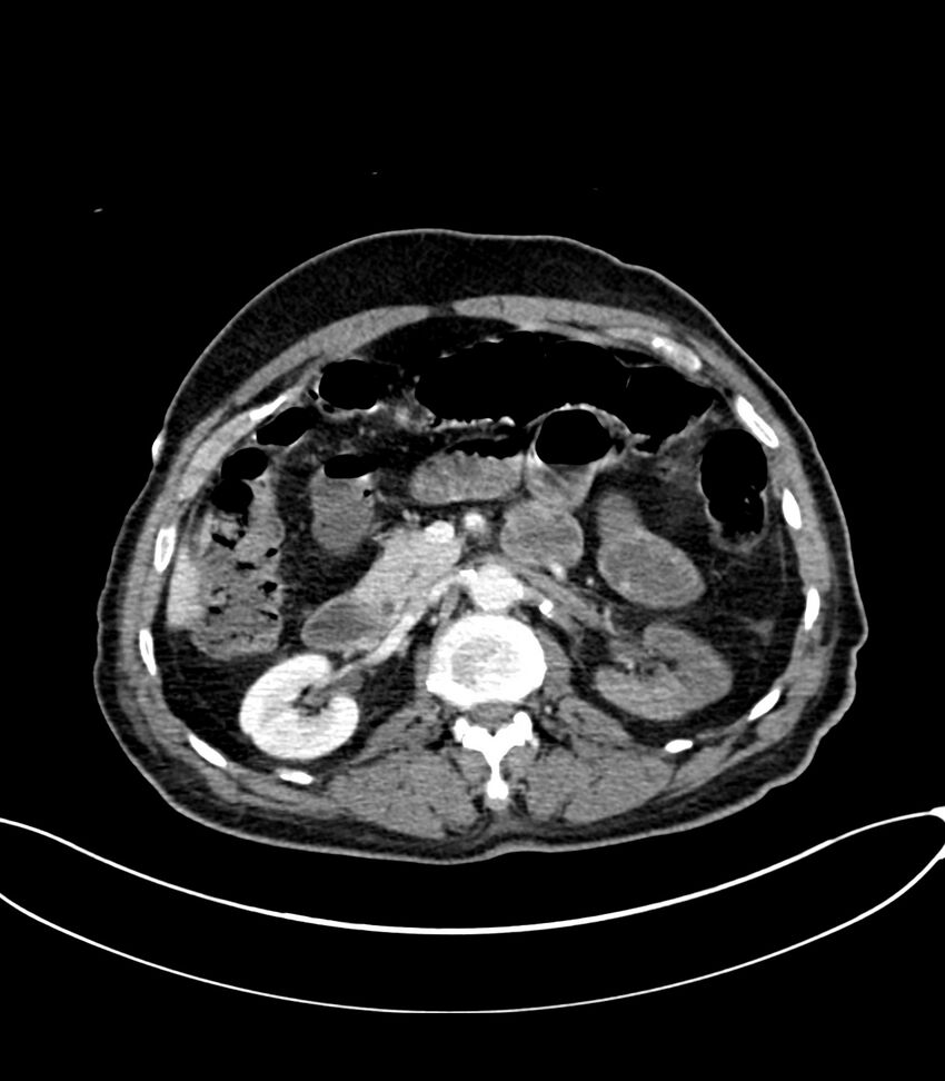 Acute arterial mesenteric ischemia (Radiopaedia 78238-90828 Axial C+ portal venous phase 54).jpg