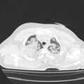 Acute aspiration pneumonitis (Radiopaedia 33605-34703 Axial lung window 22).jpg