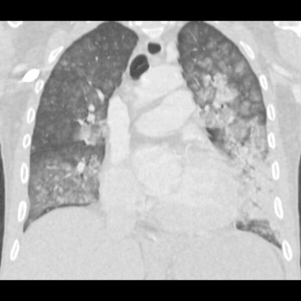 File:Acute diffuse alveolar hemorrhage (Radiopaedia 41323-44158 Coronal lung window 23).jpg