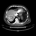 Acute heart failure (CT) (Radiopaedia 79835-93075 Axial C+ arterial phase 55).jpg