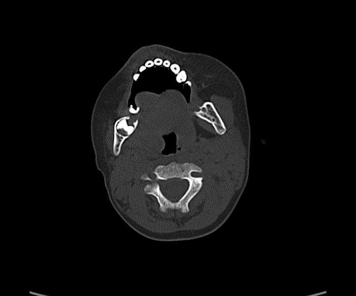 File:Acute hemorrhagic contusion (Radiopaedia 63660-72336 Axial bone window 1).jpg