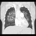 Acute pulmonary edema on CT (Radiopaedia 33582-34672 Coronal lung window 13).jpg