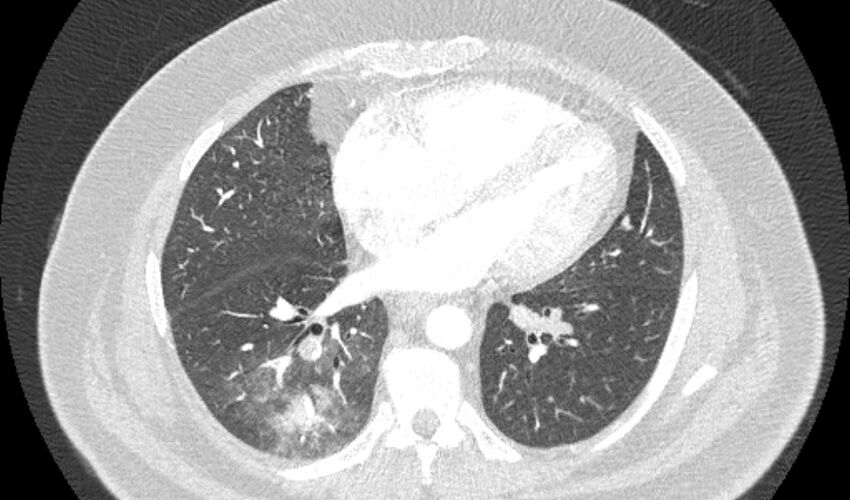 Acute pulmonary embolism with pulmonary infarcts (Radiopaedia 77688-89908 Axial lung window 79).jpg