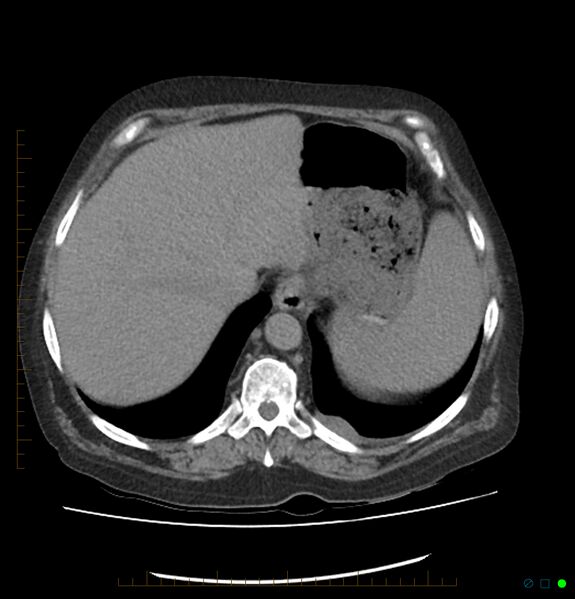File:Acute renal failure post IV contrast injection- CT findings (Radiopaedia 47815-52557 Axial non-contrast 14).jpg