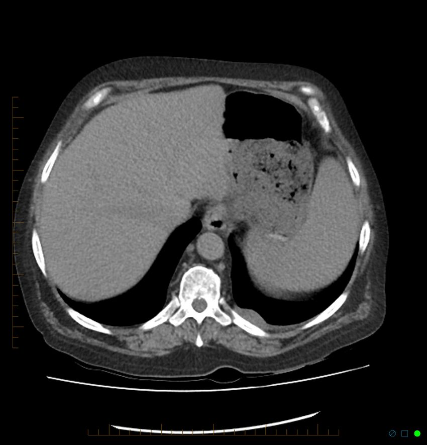 Acute renal failure post IV contrast injection- CT findings (Radiopaedia 47815-52557 Axial non-contrast 14).jpg
