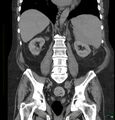 Acute renal failure post IV contrast injection- CT findings (Radiopaedia 47815-52557 Coronal non-contrast 31).jpg