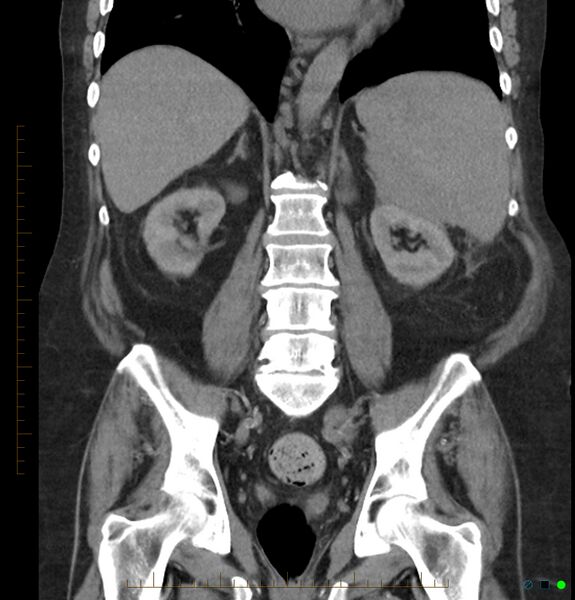 File:Acute renal failure post IV contrast injection- CT findings (Radiopaedia 47815-52557 Coronal non-contrast 31).jpg