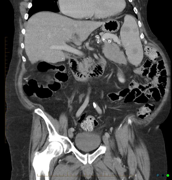 File:Acute renal failure post IV contrast injection- CT findings (Radiopaedia 47815-52559 Coronal C+ portal venous phase 11).jpg