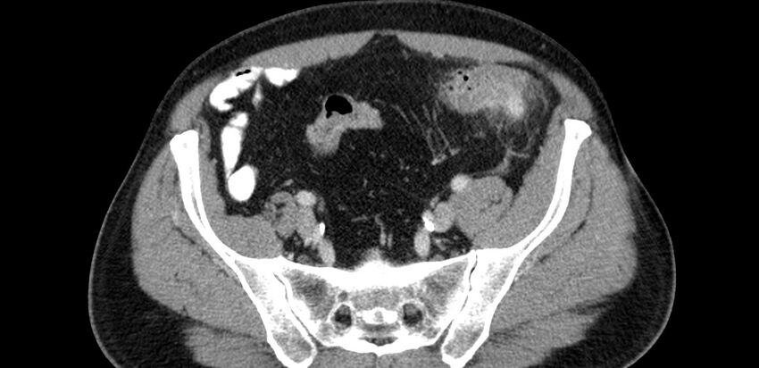 Acute sigmoid colon diverticulitis (Radiopaedia 55507-61976 Axial C+ portal venous phase 77).jpg