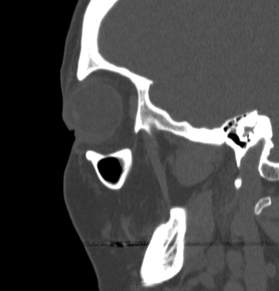 File:Acute sinusitis (Radiopaedia 22419-22455 Sagittal non-contrast 3).jpg