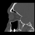 Acute sinusitis (Radiopaedia 23161-23215 Sagittal bone window 45).jpg