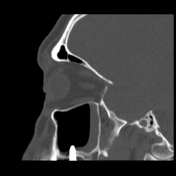 File:Acute sinusitis (Radiopaedia 23161-23215 Sagittal bone window 45).jpg