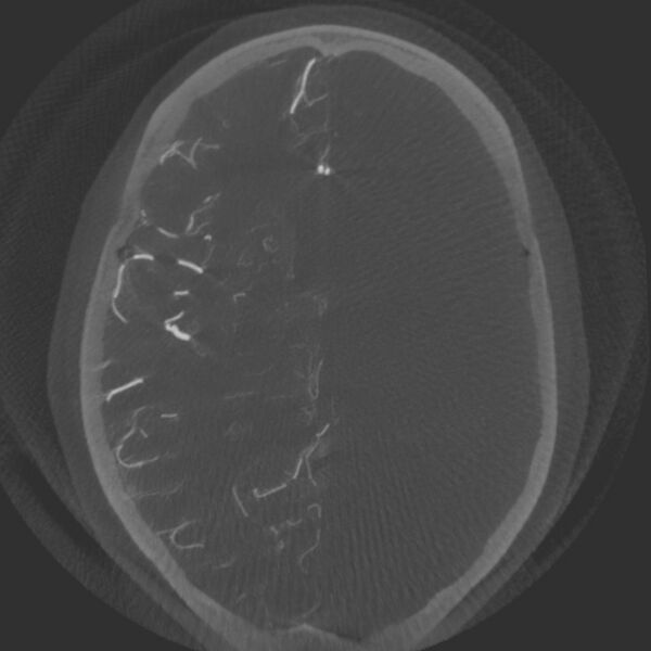 File:Acute subarachnoid hemorrhage and accessory anterior cerebral artery (Radiopaedia 69231-79010 Axial arterial - MIP 44).jpg