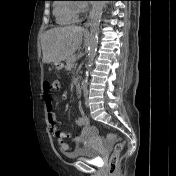 File:Acute tubular necrosis (Radiopaedia 28077-28334 H 49).jpg
