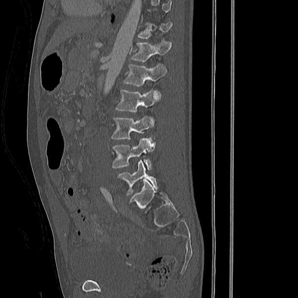 File:Acute vertebral body compression fractures (Radiopaedia 31757-32693 Sagittal bone window 16).jpg