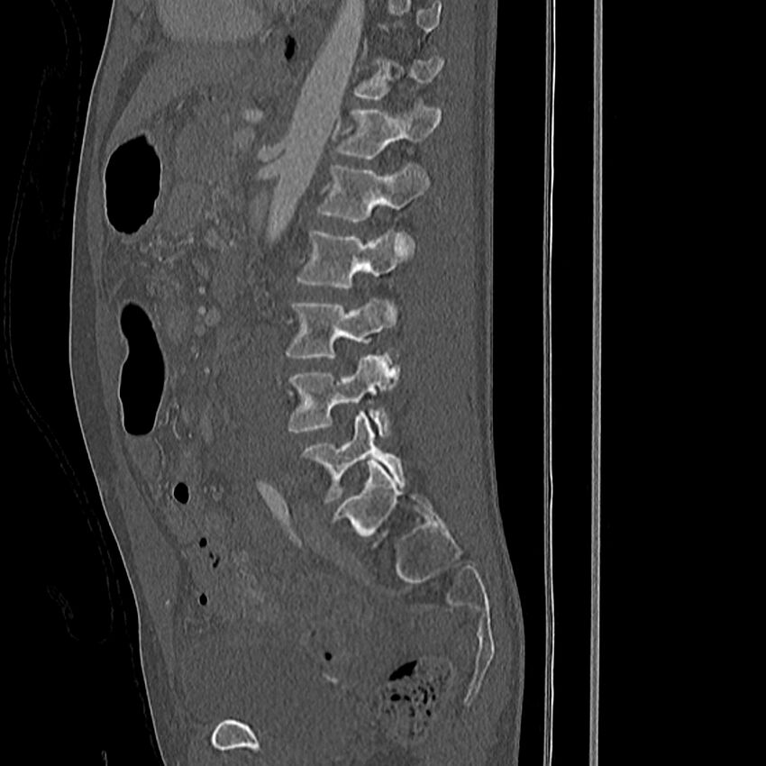 Acute vertebral body compression fractures (Radiopaedia 31757-32693 Sagittal bone window 16).jpg