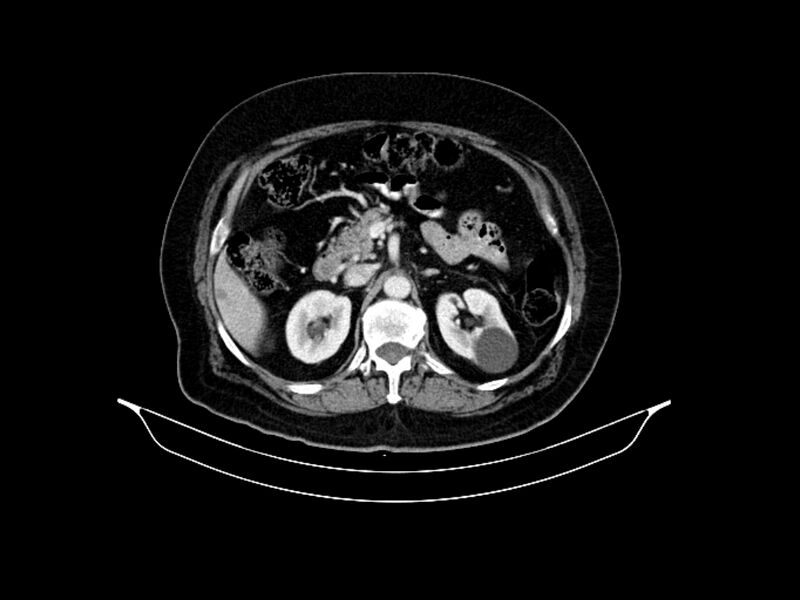 File:Adenocarcinoma of pancreas with hepatic metastasis (Radiopaedia 64332-73122 Axial C+ portal venous phase 38).jpg