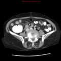 Adenocarcinoma of the colon (Radiopaedia 8191-9039 Axial liver window 47).jpg