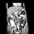 Adenocarcinoma of the colon (Radiopaedia 8191-9039 Coronal liver window 18).jpg
