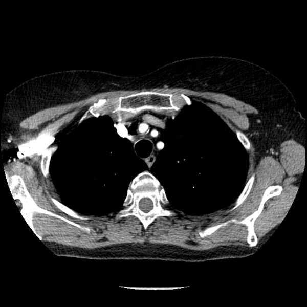 File:Adenocarcinoma of the lung (Radiopaedia 41015-43755 Axial C+ portal venous phase 22).jpg