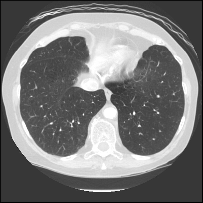 Adenocarcinoma of the lung (Radiopaedia 41015-43755 Axial lung window 95).jpg