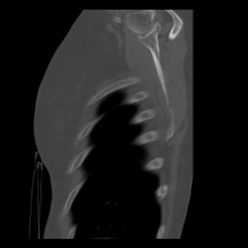 Adenocarcinoma of the lung (Radiopaedia 41015-43755 Sagittal bone window 102).jpg