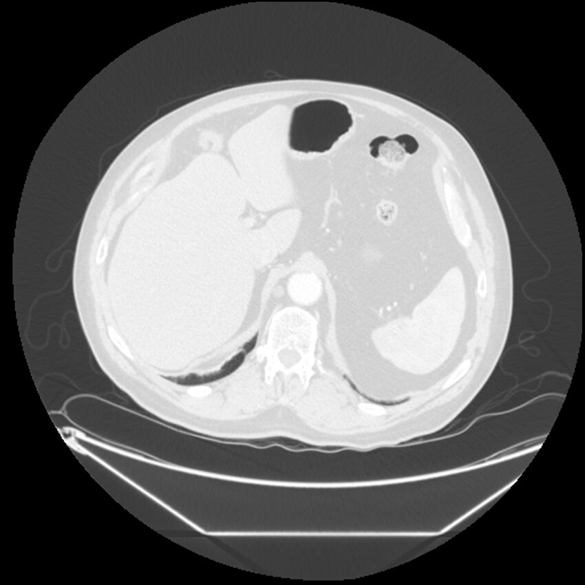 Adenocarcinoma of the lung (Radiopaedia 44876-48759 Axial lung window 77).jpg