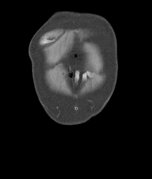 File:Adenocarcioma of rectum- T1 lesion (Radiopaedia 36921-38547 Coronal C+ portal venous phase 4).png