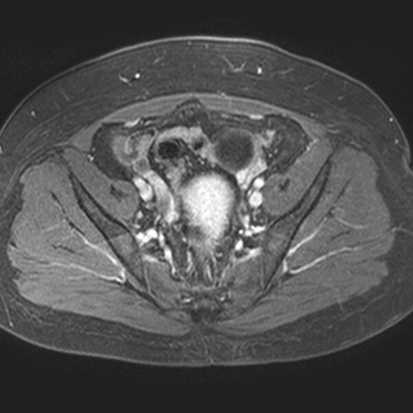 File:Adenomyoma of the uterus (Radiopaedia 9871-10439 Axial T1 C+ fat sat 17).jpg