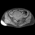 Adenomyoma of the uterus (huge) (Radiopaedia 9870-10438 Axial T1 fat sat 20).jpg