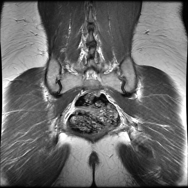 File:Adenomyosis on MRI (Radiopaedia 29328-29780 Coronal T2 1).jpg