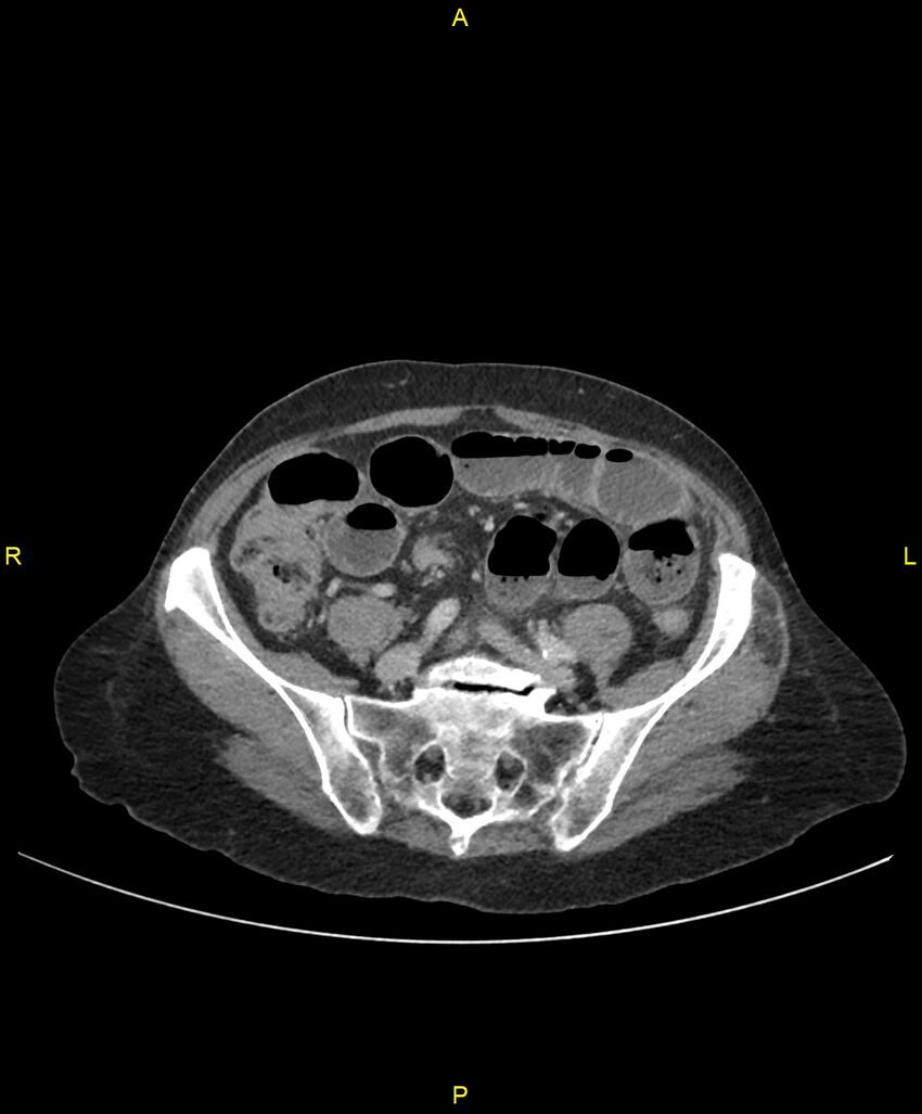 Adhesional small bowel obstruction (Radiopaedia 85402-101024 Axial C+ portal venous phase 200).jpg