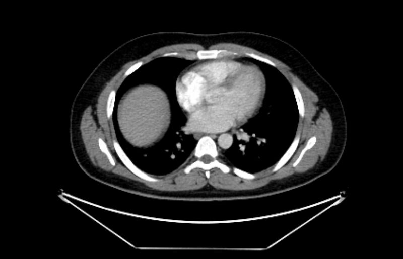 File:Adrenocortical carcinoma (Radiopaedia 80134-93438 Axial C+ portal venous phase 1).jpg