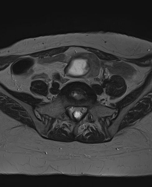 File:Adult granulosa cell tumor of the ovary (Radiopaedia 71581-81950 Axial T2 6).jpg