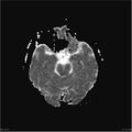 Amnestic syndrome secondary to hypoxic brain injury (Radiopaedia 24743-25004 ADC 12).jpg