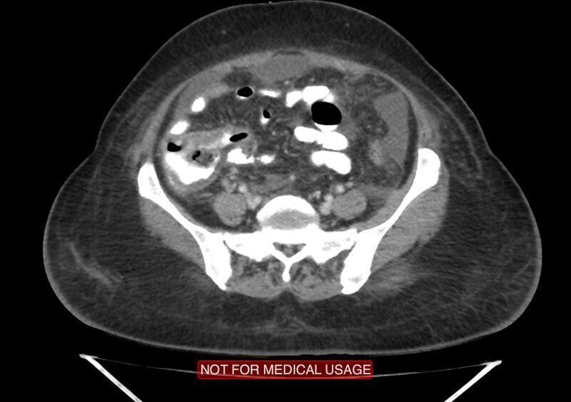 File:Amoebic enterocolitis with liver abscess (Radiopaedia 35100-36609 A 59).jpg
